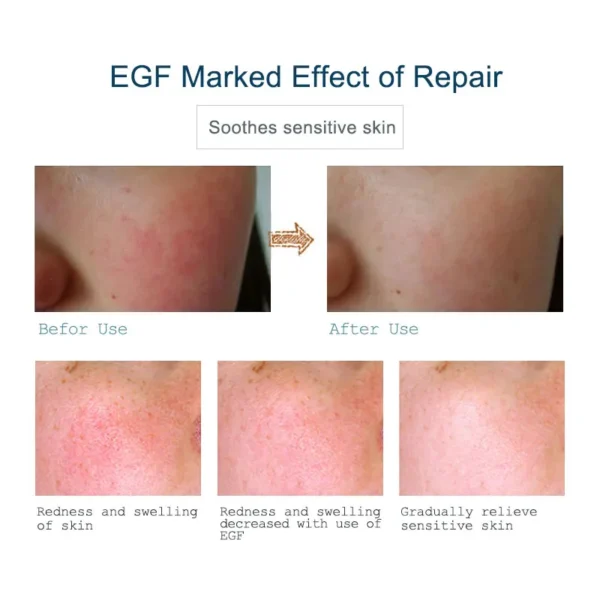 ARTISCARE EGF 3PCS for Moisturizing Face Serum Blackhead Skin Care Repair Essence - Image 3